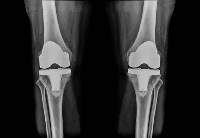 Both Knee Replacement