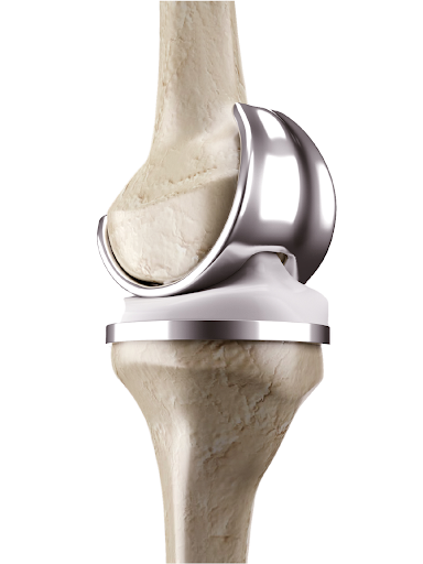 Single Knee Replacement